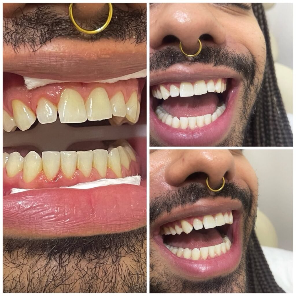 Antes e depois de clareamento dental na Leviss Odontologia