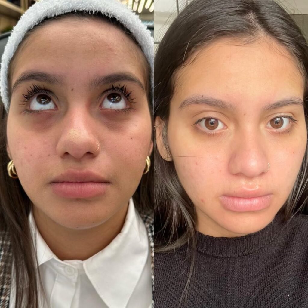 Antes e depois de harmonização facial na Leviss Odontologia