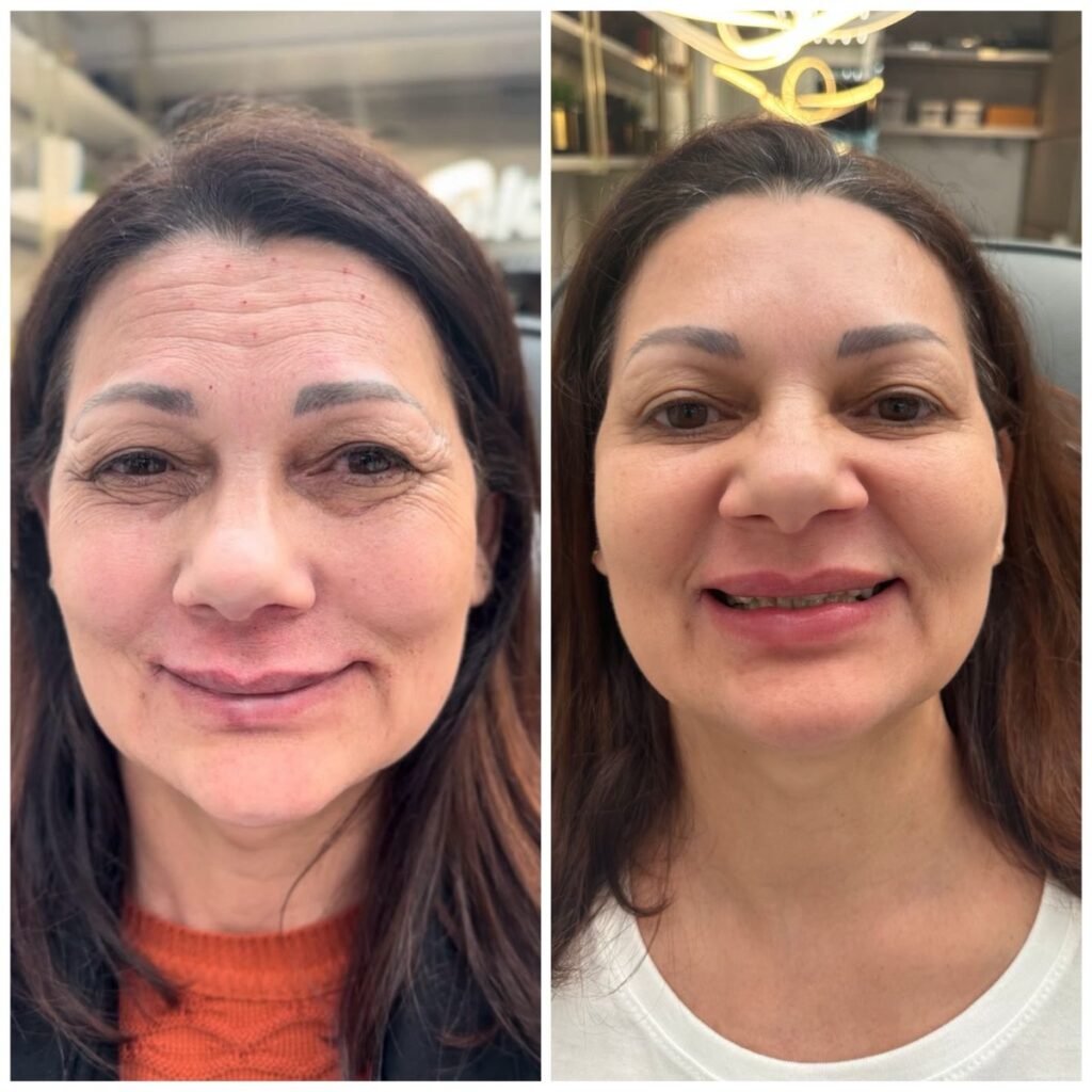 Antes e depois de harmonização facial na Leviss Odontologia