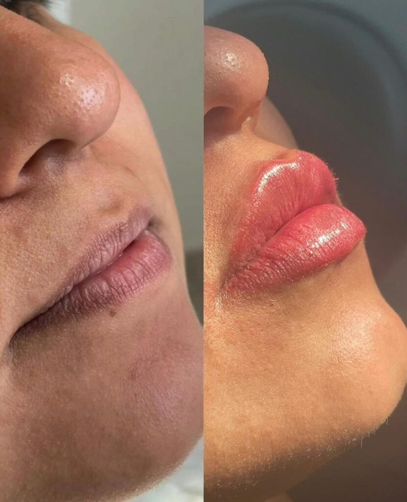 Antes e depois de harmonização facial na Leviss Odontologia