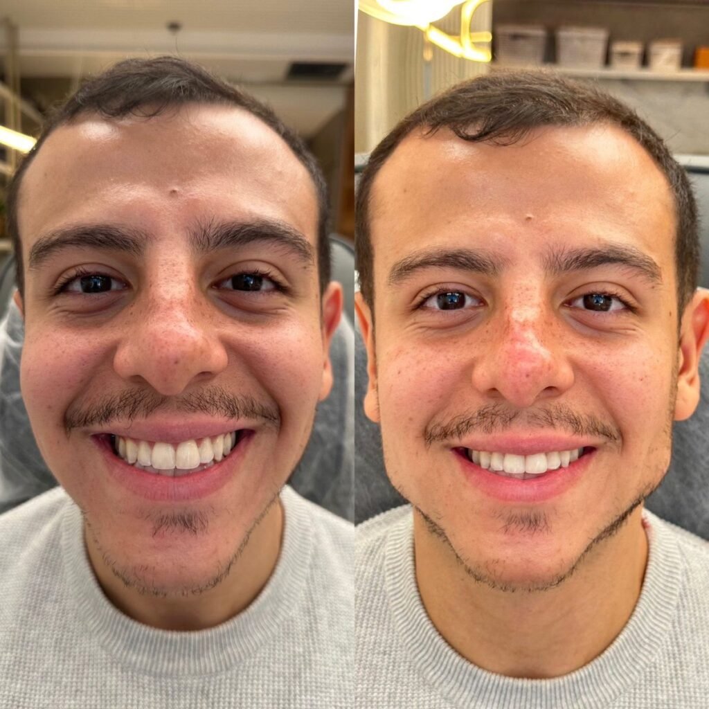 Antes e depois de harmonização facial na Leviss Odontologia