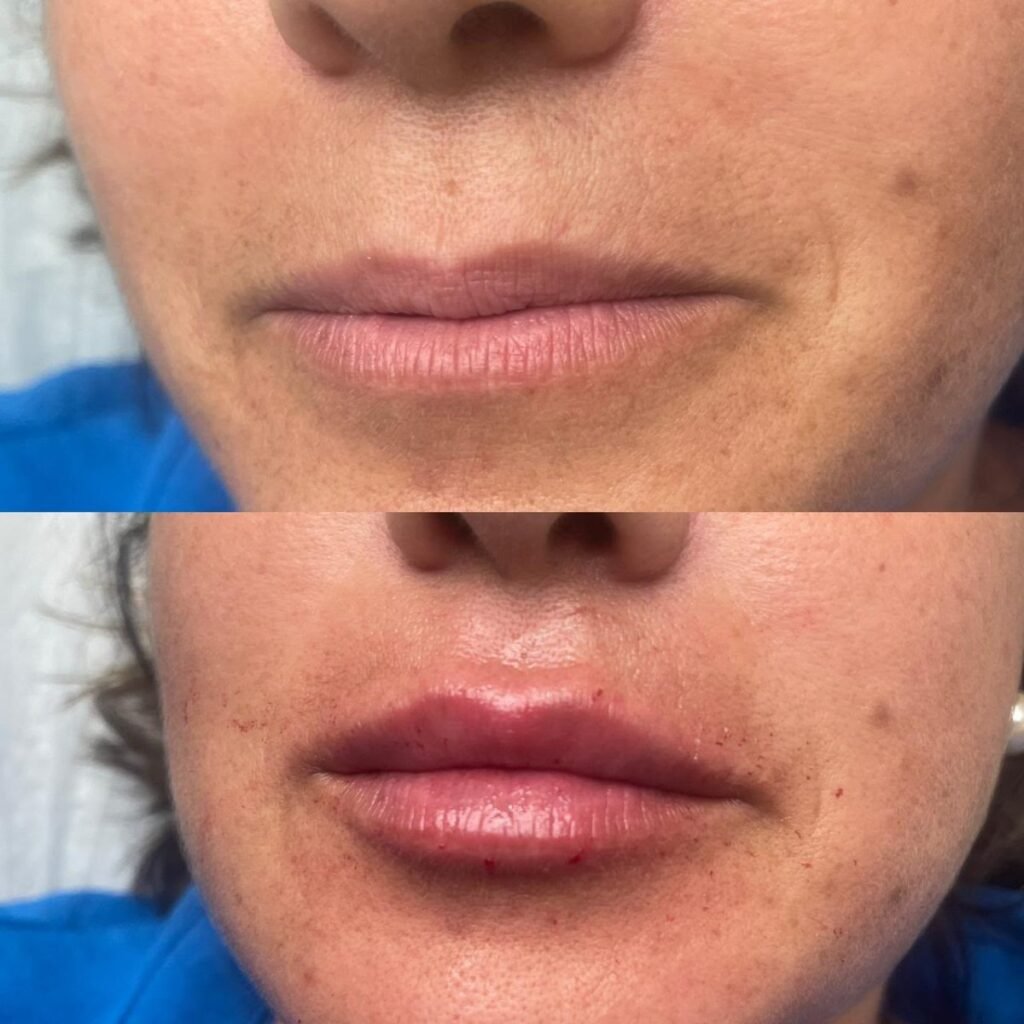 Antes e depois de harmonização facial na Leviss Odontologia