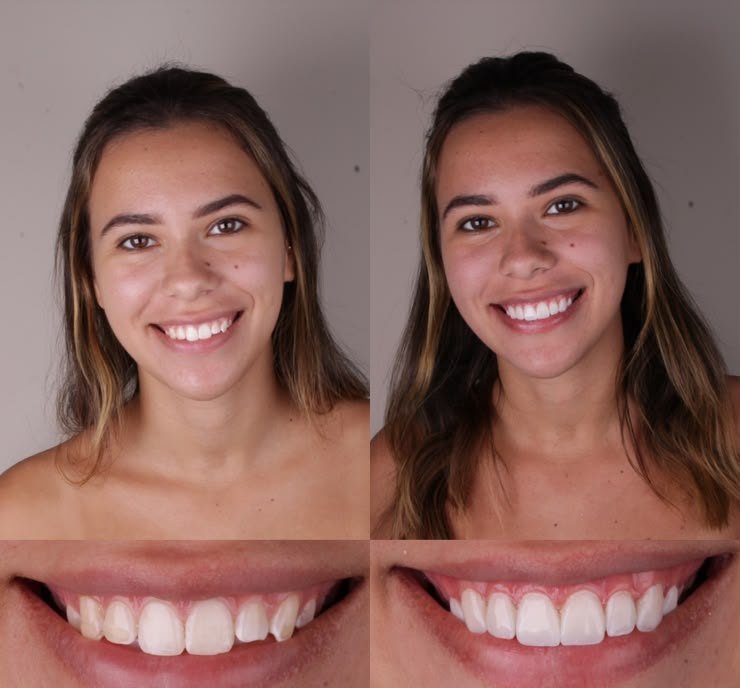 Antes e depois de lentes dentais na Leviss Odontologia