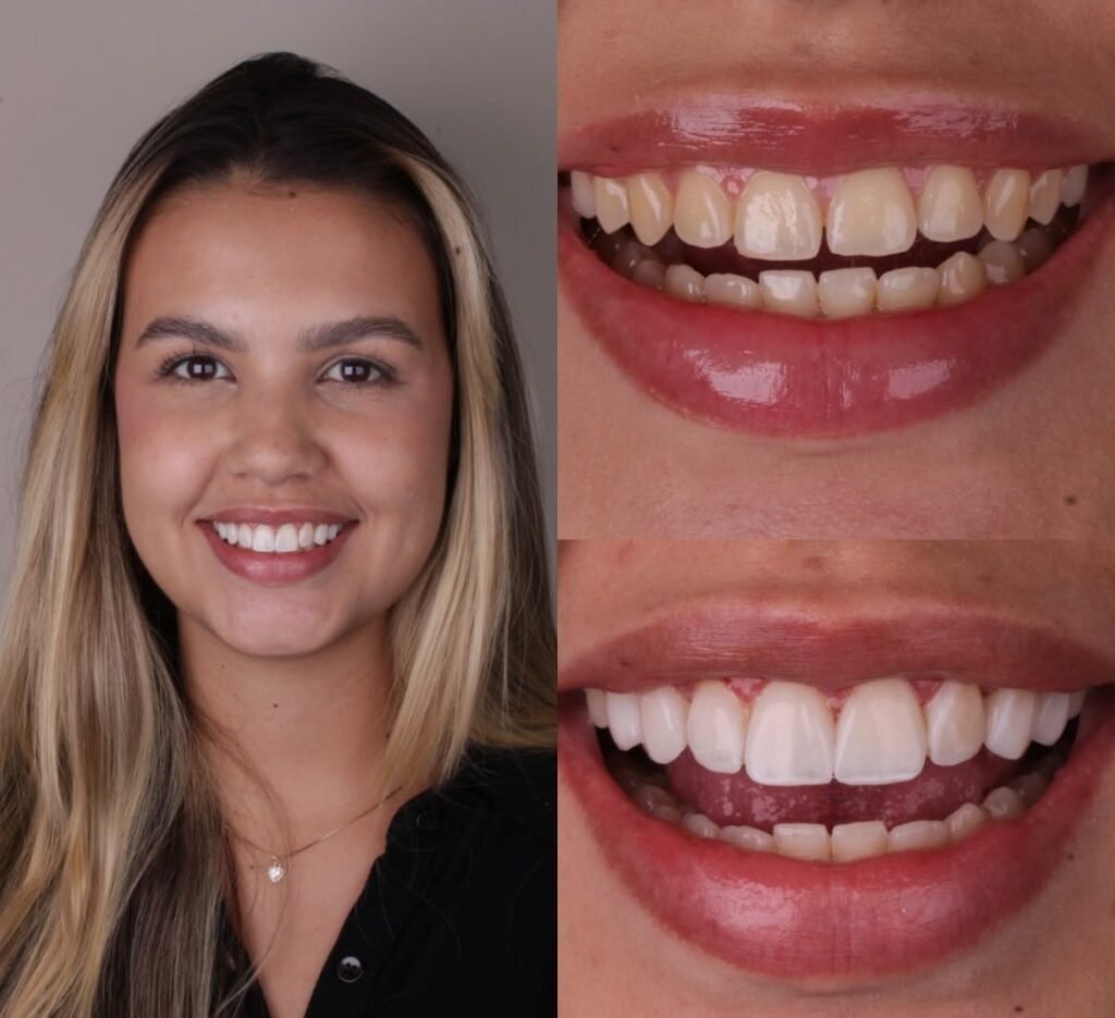 Antes e depois de lentes dentais na Leviss Odontologia